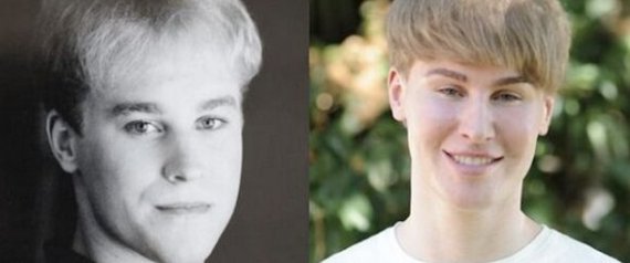 Justin Bieber Plastic Surgery