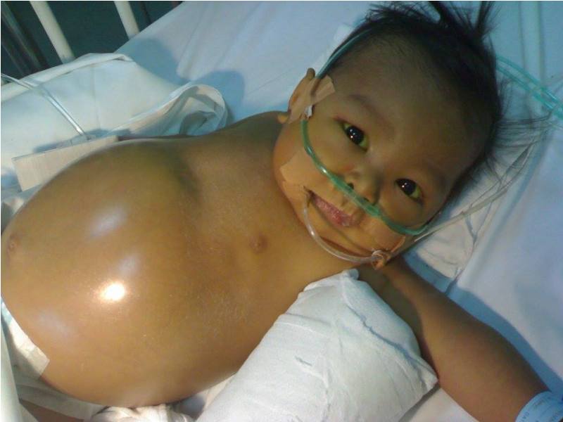 Call for Help: Save Baby Arianne from Biliary Atresia 2 Save Baby Arianne from BA (3)