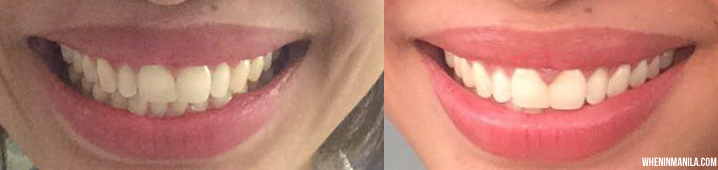 fashion smile zoom teeth whitening