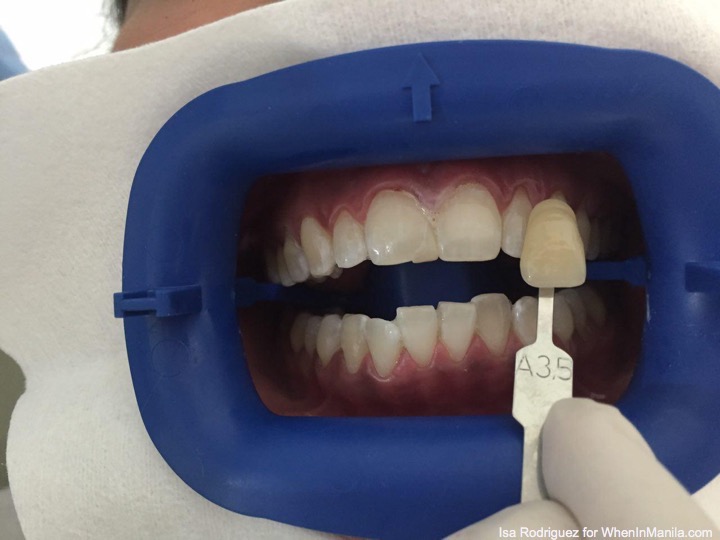 THE DENTIST IS IN: Check Up, Cleaning, Zoom Teeth Whitening at Fashion Smile Dental Clinic 5 fashionsmile-photo_2016-07-28_16-45-38