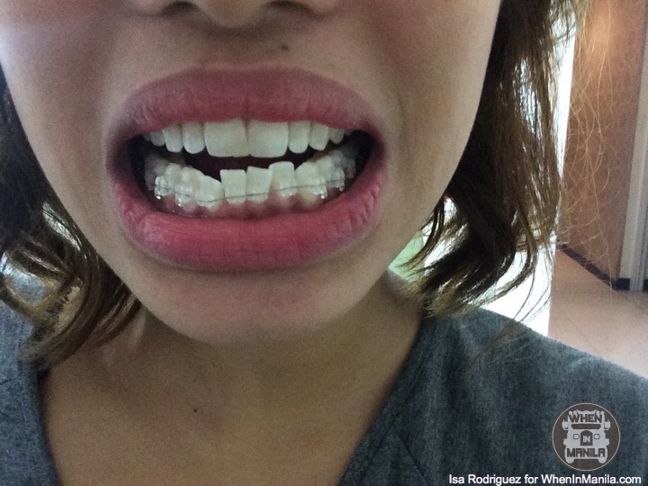 GETTING THE PERFECT SMILE: Molar Tooth Extraction & My ... GETTING THE PERFECT SMILE: Molar Tooth Extraction & My ...