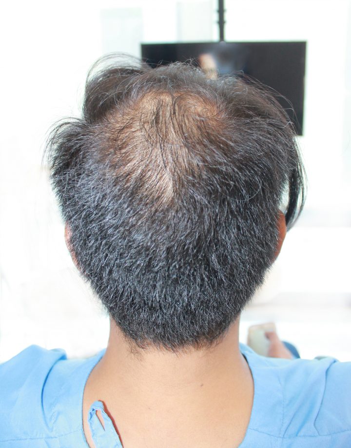Suki Salvador's Hair Game Is Strong With Svenson Hair Transplant