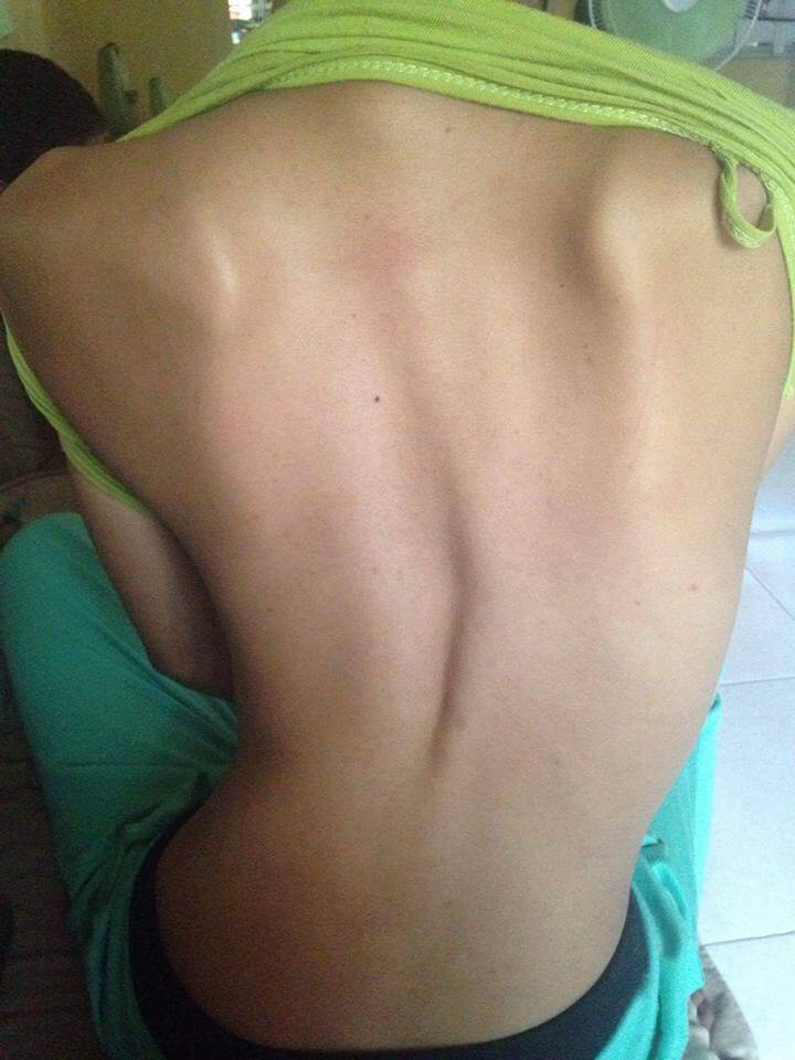 scoliosis story 2