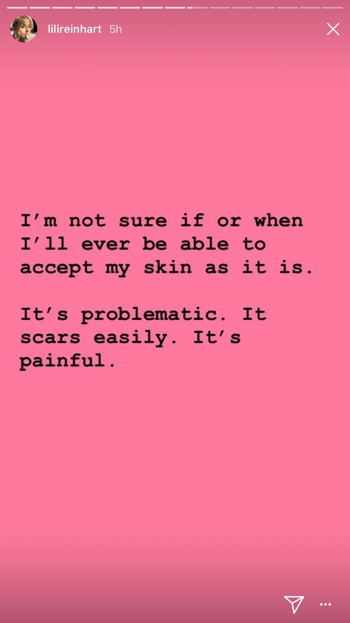 INSPIRING: 'Riverdale' actress Lili Reinhart speaks up on cystic acne insecurities 7 2018 05 23 15.12.07