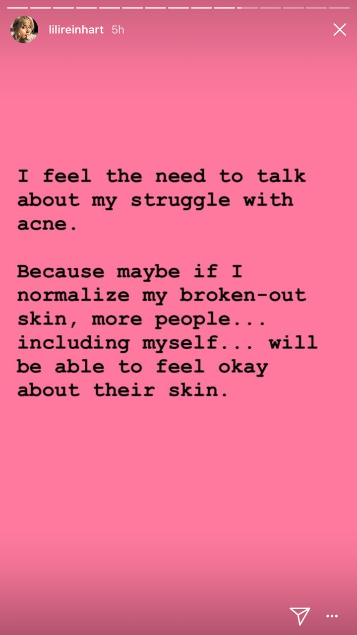 INSPIRING: 'Riverdale' actress Lili Reinhart speaks up on cystic acne insecurities 9 2018 05 23 15.12.14