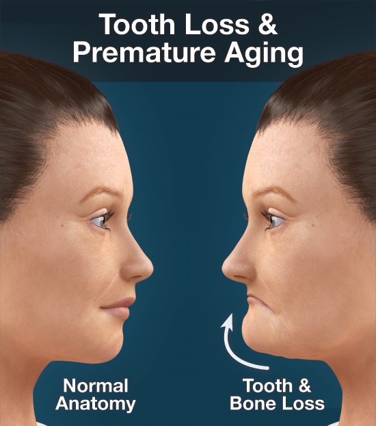 tooth loss and premature aging large