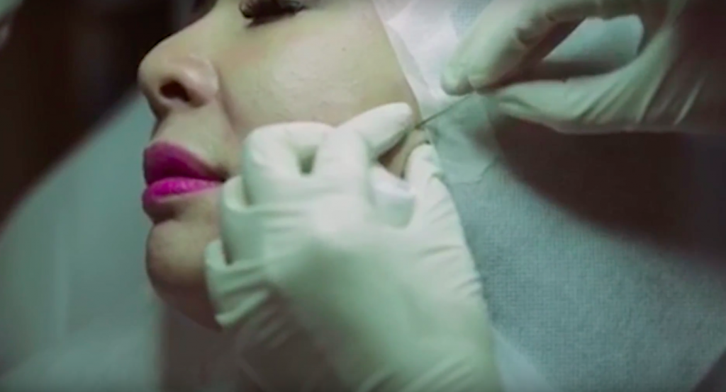 Happylift: The Non-Invasive Way to Lift Your Face 2 HappyLift5