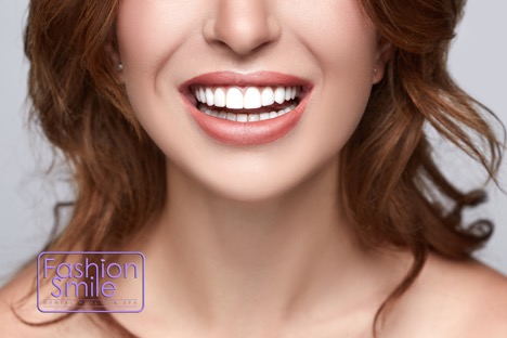 Direct Composite Veneers: Smile Like a Star in Just One Visit 1 Smile Like a Star 1