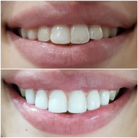 Direct Composite Veneers: Smile Like a Star in Just One Visit 2 Smile Like a Star 2