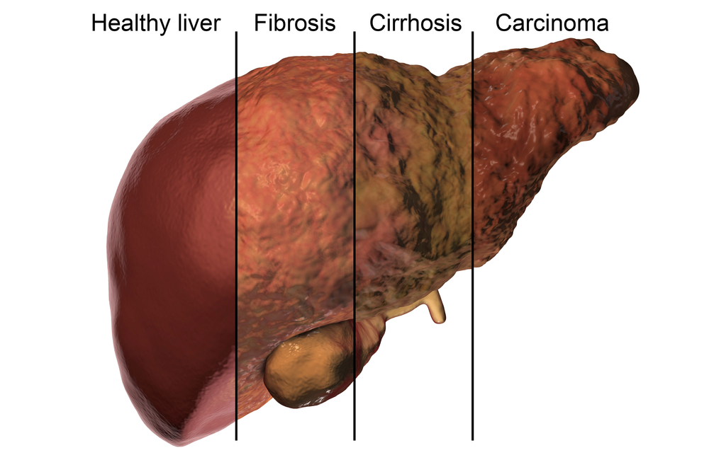 The danger of damaging your liver