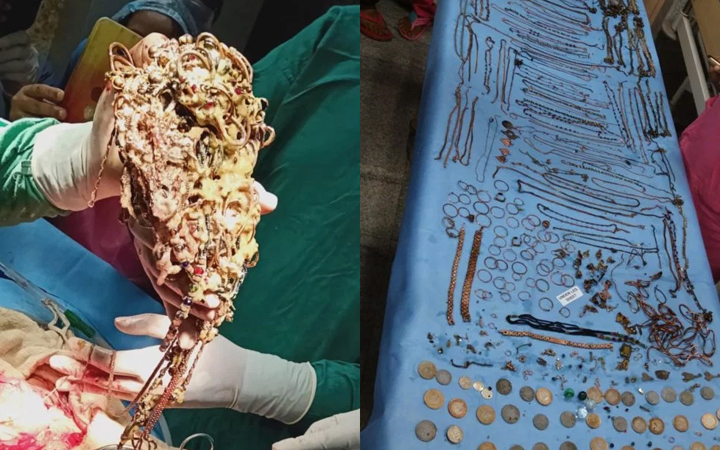 jewelry in stomach