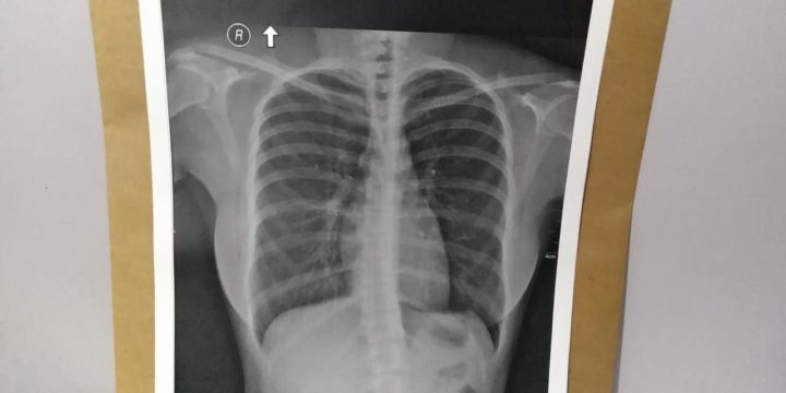 Xray Scoliosis e1567987494967