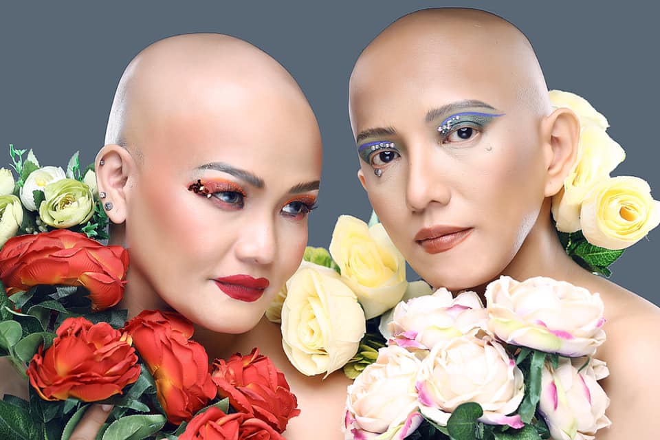 Alopecia Philippines 1