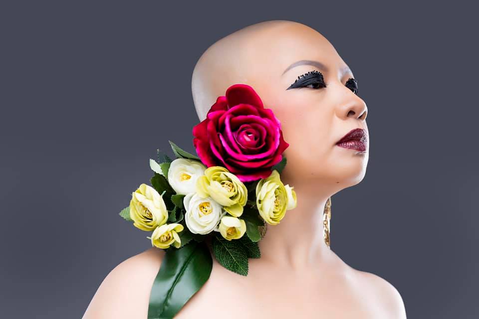 Alopecia Philippines 3