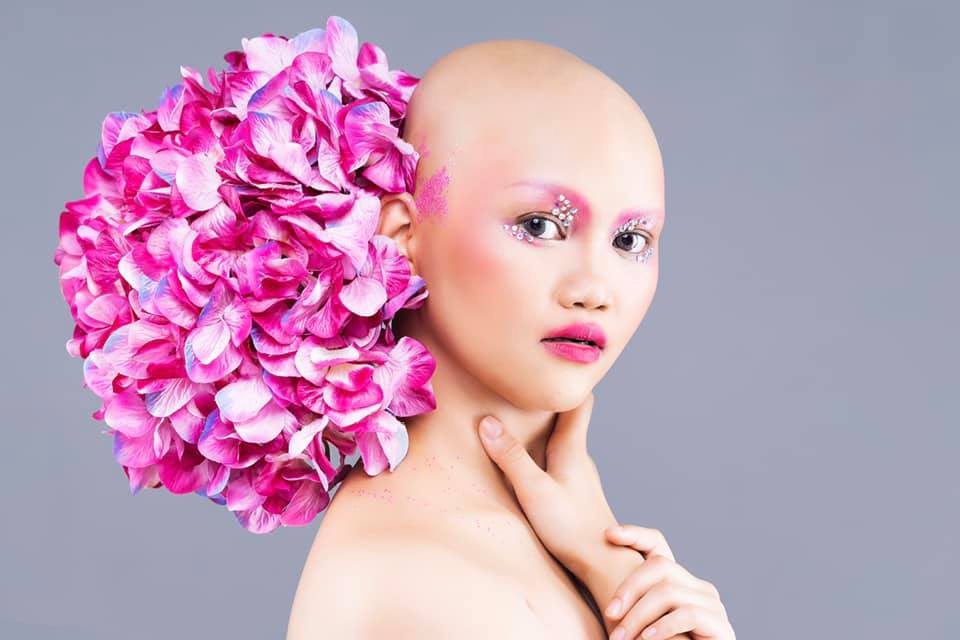 Alopecia Philippines 4