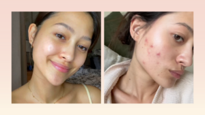 Maureen Wroblewitz Gets Candid About Her Acne Problems