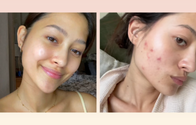 Maureen Wroblewitz Gets Candid About Her Acne Problems