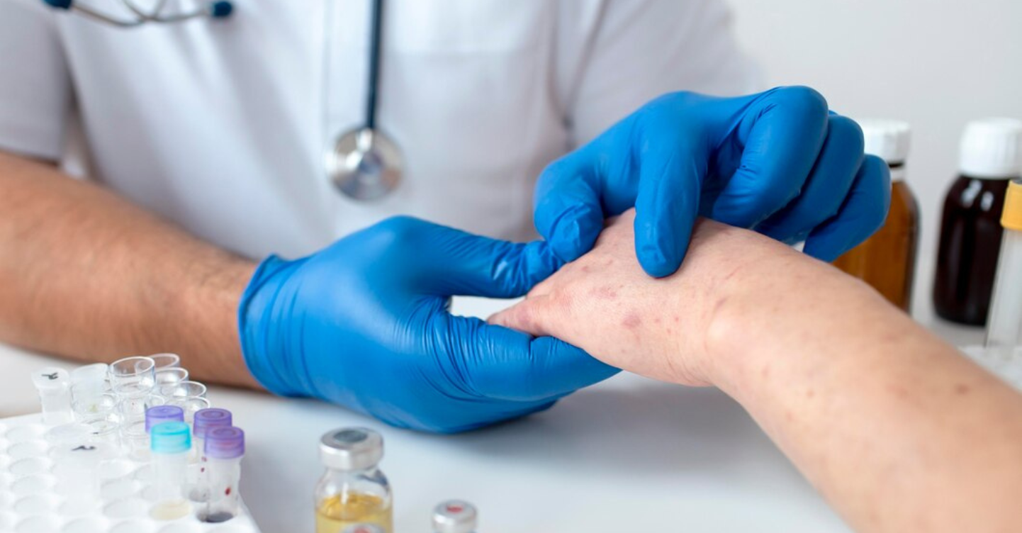 UP Mathematicians Develop Algorithm To Simulate Monkeypox Spread When 