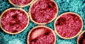 New Mpox Case Detected in PH—DOH Confirms 1 Mpox virus