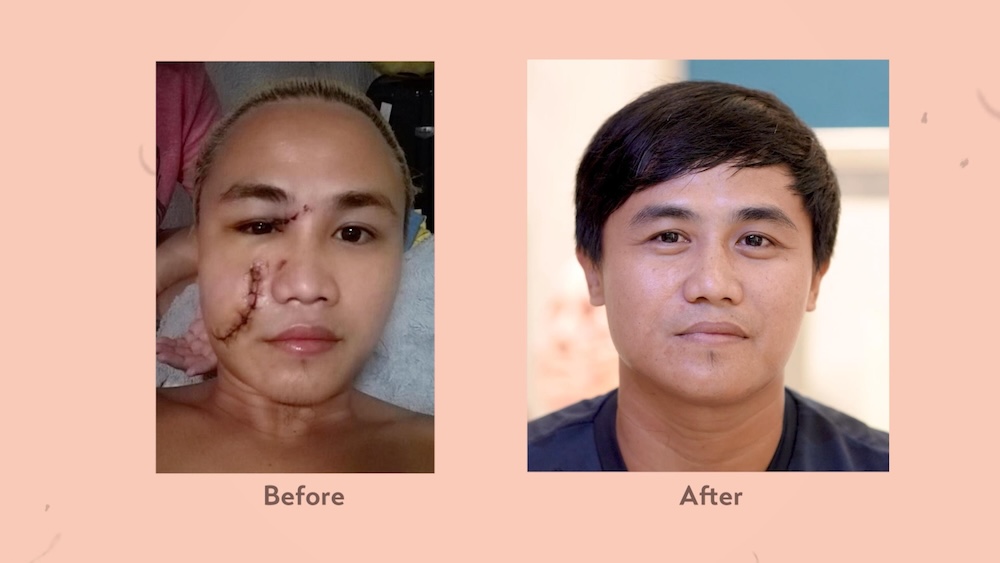 Belo Medical Group | The Scar Project | Vicky Belo, Hayden Kho